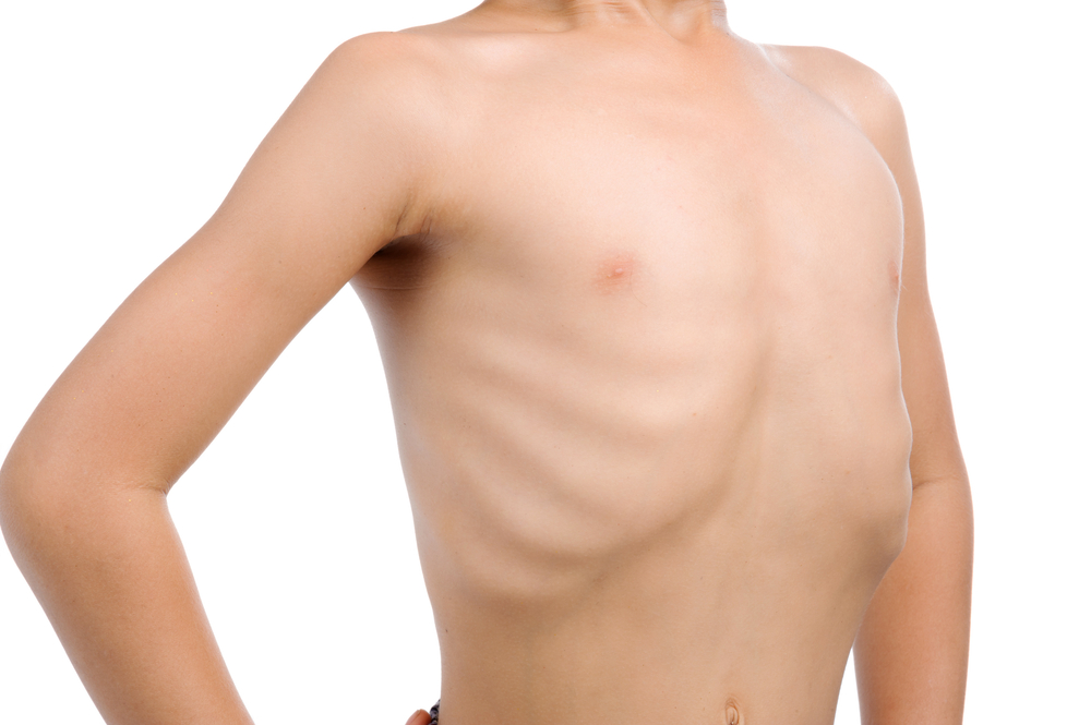 Trẻ suy dinh dưỡng thể teo đét gầy trơ xương